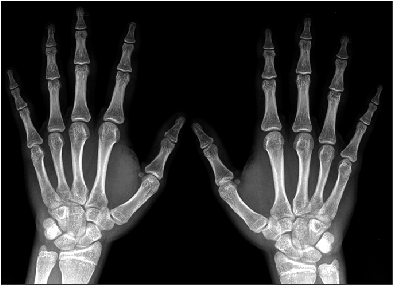 X-Ray